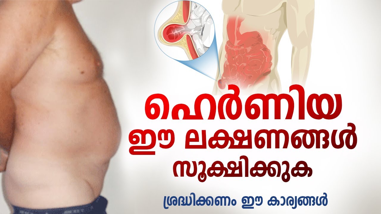 ഹെർണിയ ഈ ലക്ഷണങ്ങൾ സൂക്ഷിക്കുക | വളരെ പ്രധാനപ്പെട്ട ഇൻഫർമേഷൻ | Hernia Symptoms