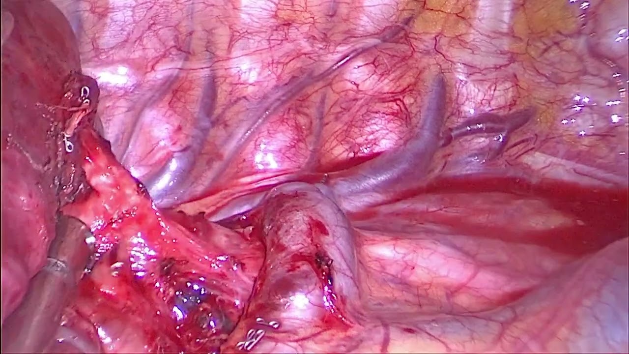 Single port VATS RS1 segmentectomy