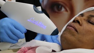 CooLift Treatment