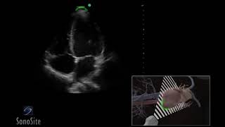 3D How To  Apical 4 Chamber View, Echocardiography