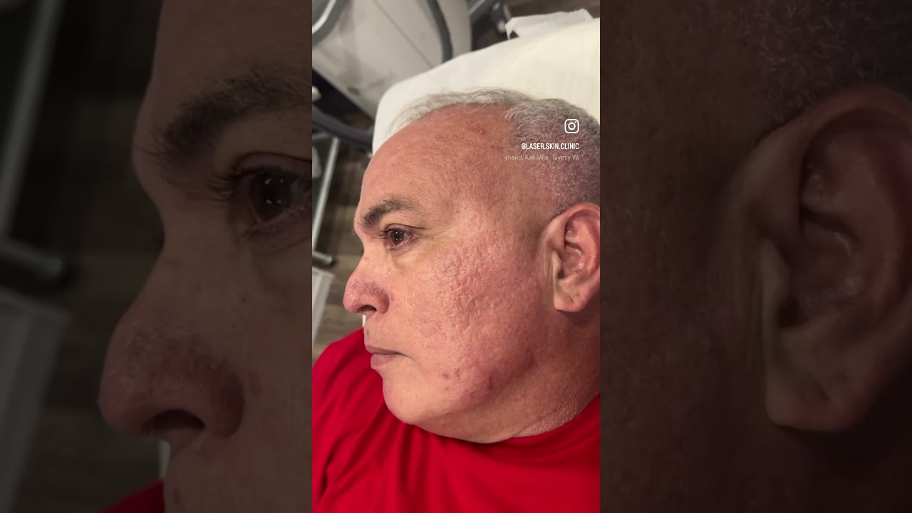 ResurFX Lumenis Stellar M22