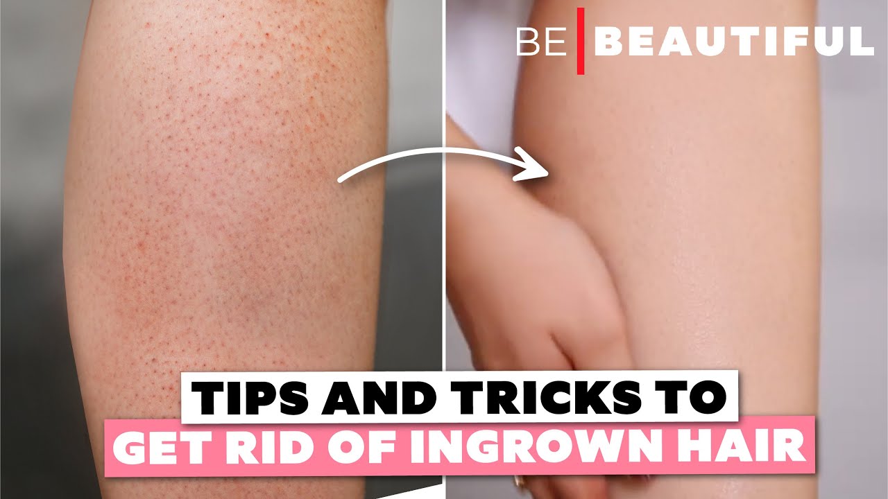 Tips & Tricks To Get Rid Of Ingrown Hair | Shaving Tips To Avoid Strawberry  Legs | Be Beautiful - thptnganamst.edu.vn