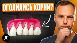 видео: Десна “УШЛА” от зуба? Что делать, чтобы НЕ ПОТЕРЯТЬ зуб? Посмотри, если у тебя проблемы с дёснами! картинка: Десна “УШЛА” от зуба? Что делать, чтобы НЕ ПОТЕРЯТЬ зуб? Посмотри, если у тебя проблемы с дёснами!
