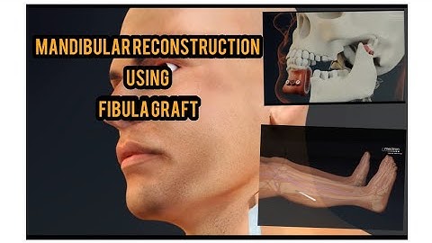 Mandibular reconstruction using Fibula graft #doctor #medico #aligarh #amu #omfs #dentistry