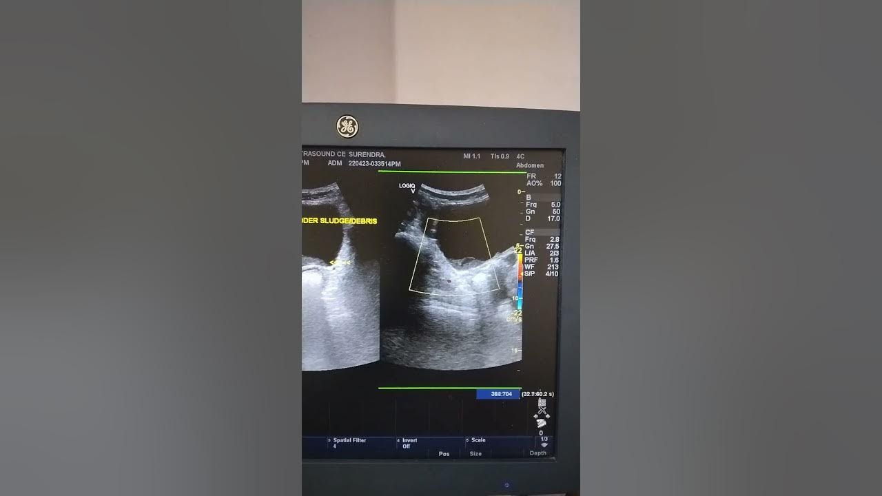 Urinary Bladder Sludge Debris Ultrasound YouTube urinary-bladder-sludge-debris-ultrasound-youtube
