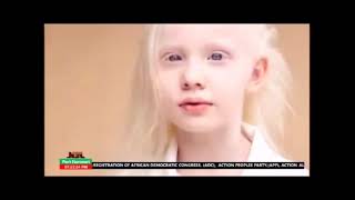 ON THE CHALLENGES OF PEOPLE LIVING WITH ALBINISM: TAKE A LISTEN - 15TH JUNE 2026