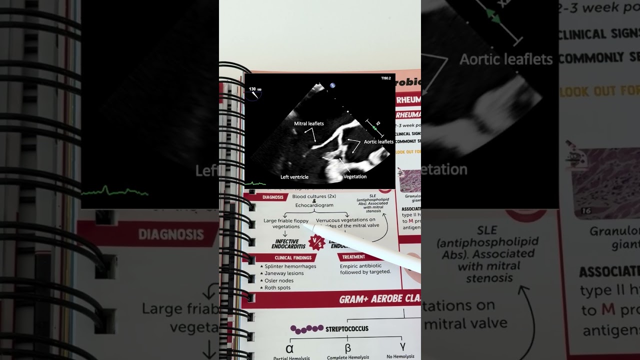 День 1/30: Инфекционный эндокардит 🦠🫀