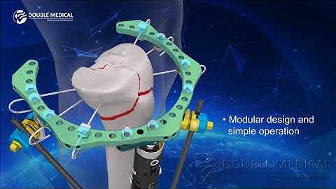 Hybrid External Fixator