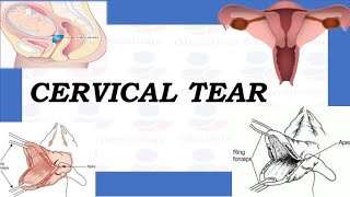How to Repair Cervical Tear or Cervical Laceration? | TOACS \& OSCE Station