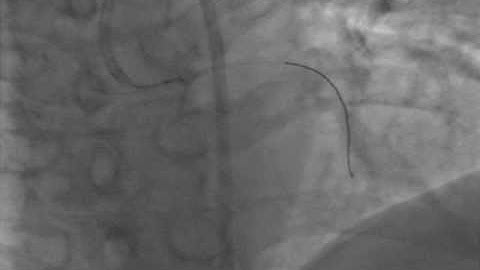 stent retieval andrasnare.avi