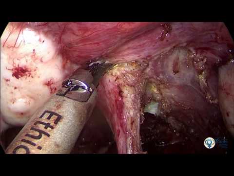 Vídeo: Cirurgia Para Endometriose