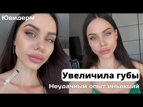 УВЕЛИЧЕНИЕ ГУБ💉👄 ДО/ПОСЛЕ🔥 СТРАХИ, НЕУДАЧНЫЙ ОПЫТ😱Убираем Носогубные складки, Ювидерм Волифт👄