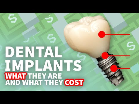 Convenient Dental Implant Benefits Columbus OH