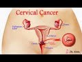 Meaning Of Cervical Cancer