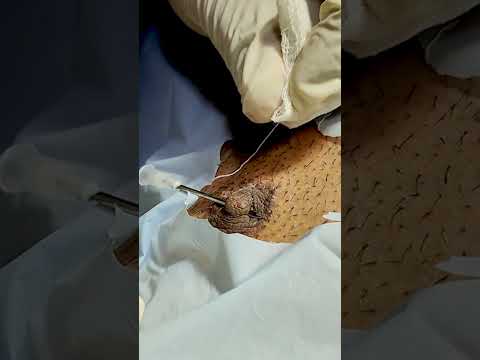 Stylish Comfortable Non Surgical Nipple Piercing Dr Ashutosh Shah Elegance Clinic Surat