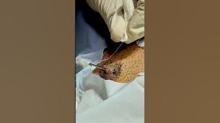 Stylish & Comfortable Non-Surgical Nipple Piercing | Dr. Ashutosh Shah | Elegance Clinic - Surat