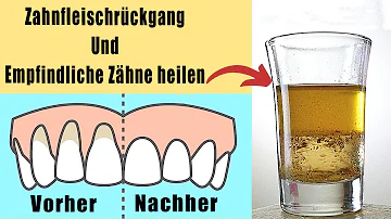 Wie lange braucht das Zahnfleisch um sich zu erholen?