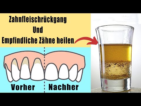 Video: Natürliche Heilmittel Gegen Zahnfleischschwund