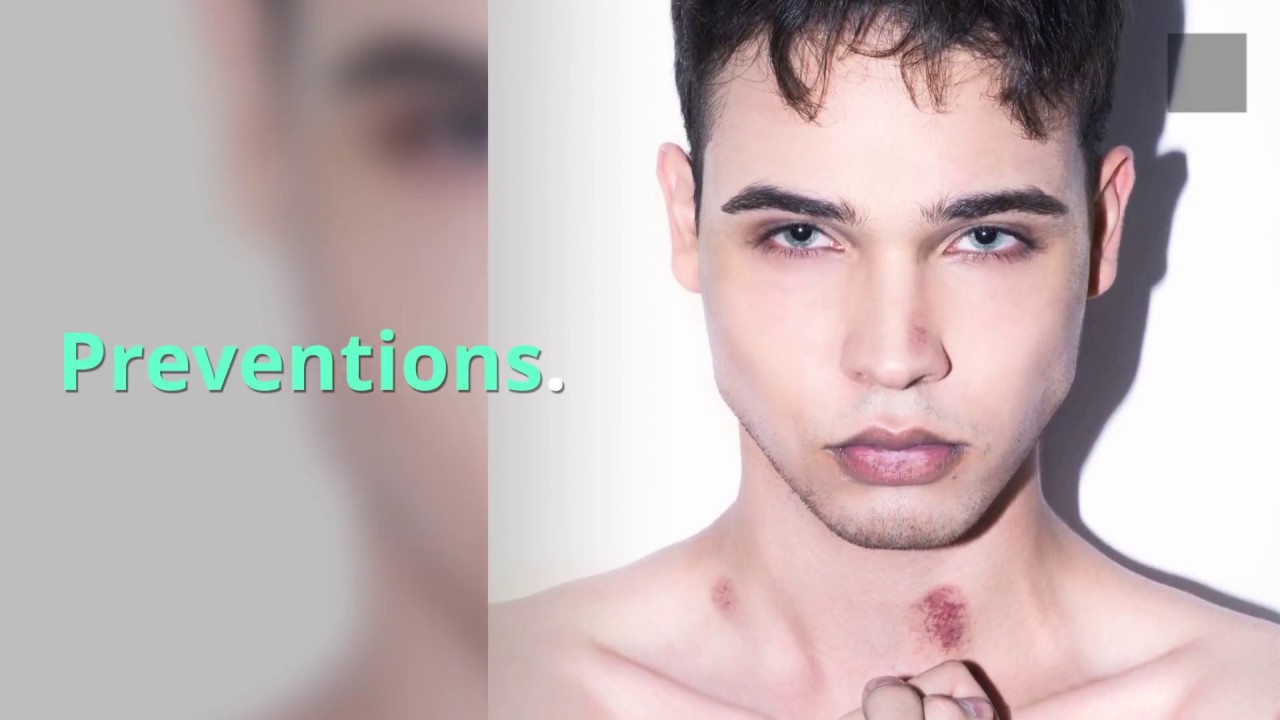 How to Get Rid of a Hickey Fast? - YouTube
