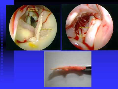 Vidéo: Élasticité Aortique Après Soulagement De La Coarctation Aortique: Comparaison De La Thérapie Chirurgicale Et Interventionnelle Par Imagerie Par Résonance Magnétique Cardiovasculair