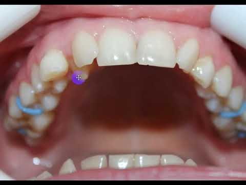 რეტენირებული კბილი, ეშვი.