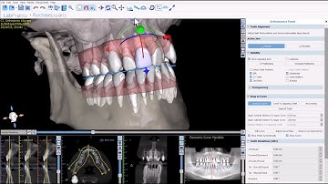 BSPV4.13: Root Based Aligner Treatment is The ONLY Way To Properly Plan AN Aligner Treatment!