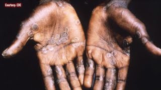 Growing concerns about spread of MPOX during Pride Month