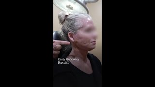Early Recovery Results