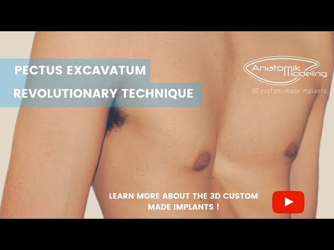 AnatomikModeling - Pectus Excavatum - EN