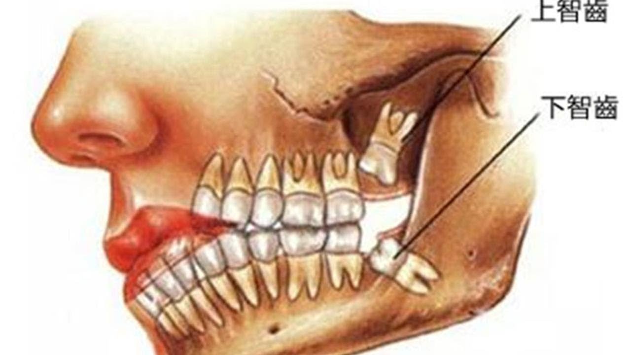 Не открывается рот челюсть. Анатомия челюсти и зубов мудрости. Зуб мудрости на нижней челюсти.