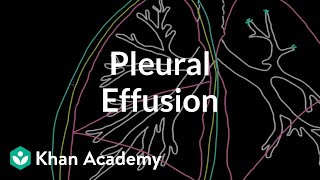 What is a pleural effusion? | Respiratory system diseases | NCLEX-RN | Khan Academy