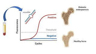 MicroRNA biomarker discovery in type-2 diabetic osteoporosis - David Carro Vázquez