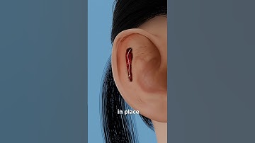 How Ear Pinning Works 🤔