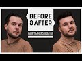No hair at the whorl and at the front? Not with a hair system!