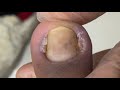 Some bad ingrown nails combination