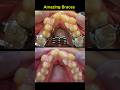 Ref:IDbA7aEYJek Amazing braces. fix crowded teeth process #braces #orthodontist #dentist