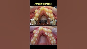 Amazing braces. Fix crowded teeth process #braces #orthodontist #dentist