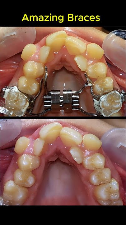 Amazing braces. Fix crowded teeth process #braces #orthodontist #dentist