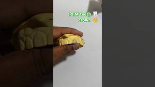 PFM teeth 🦷 crown 👑#dental #dentist #youtubeshorts #youtubevideo #tips #@mrakashgill1