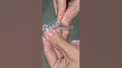 3Dresyns 3D printed aligner printed with 3Dresyn OD-Clear TF LTP Flexible at 0.7mm with LCD printers