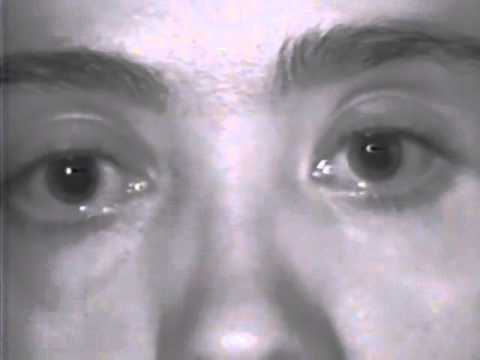 pulsating exophthalmos