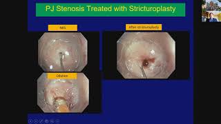 Dr. Shah-  Endoscopic Management of Chronic Pancreatitis RMH 2020