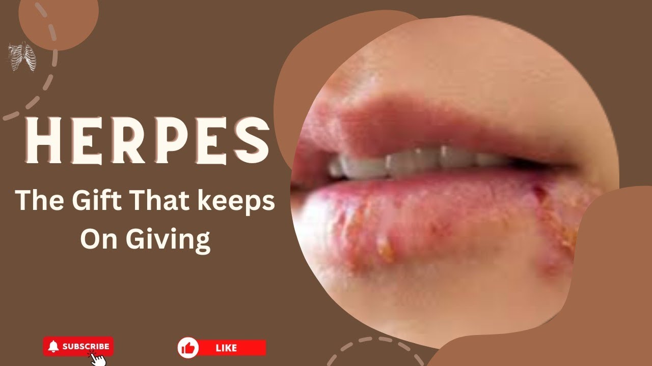 Herpes- The Gift That Keeps On Giving - YouTube