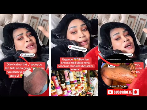 Adji Masse partage avec les sénégalais, les complications de sa chirurgie « dama narone dhé… »
