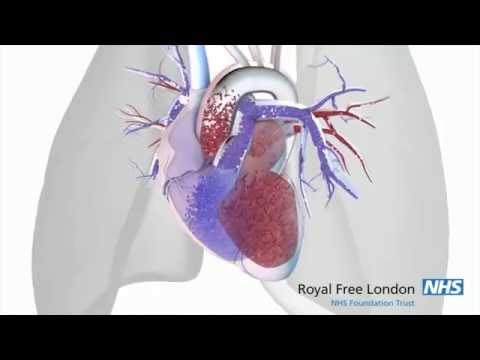 Video: Pulmonal Hypertension Ved Lymfioioleiomyomatose: Udbredelse, Sværhedsgrad Og Rollen Som Kulilte-diffusionsevne Som En Screeningsmetode