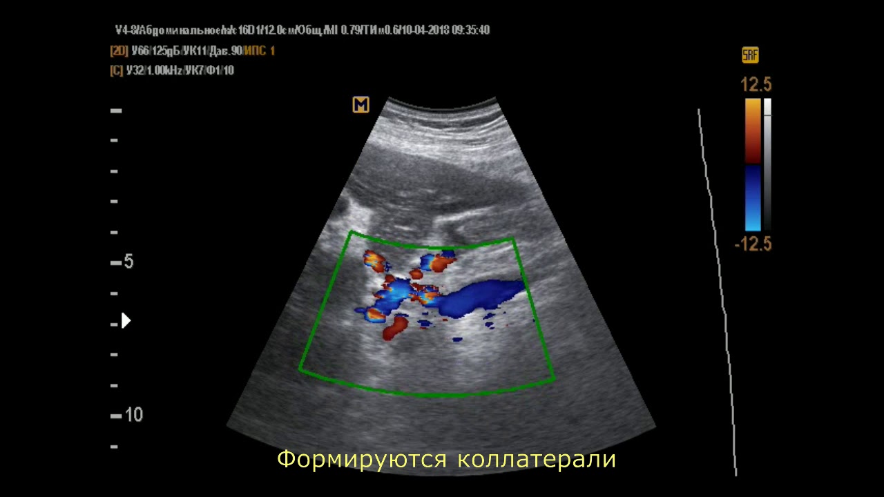 Осложнения цирроза печени (10-4-18) - YouTube