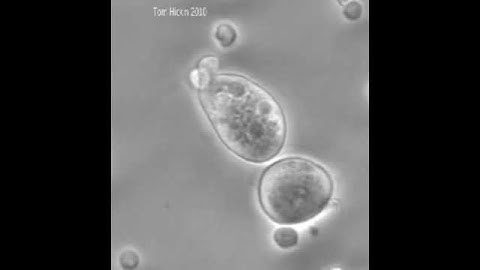 Cytotoxic T cells killing cervical cancer cells