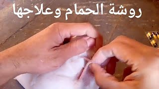 شاهد علاج الروشة # أسال مجرب ولا تسأل طبيب