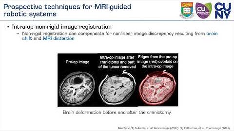 MRI Guided Robot-Assisted Stereotactic Neurosurgery