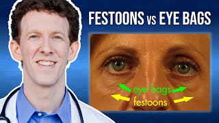 What Are Eye Festoons vs Lower Eyelid Bags?